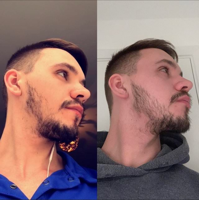 Minoxidil Before And After Beard Result : The Struggle to Grow a Beard