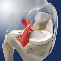 PCL Tear: How to Treat this Painful Injury