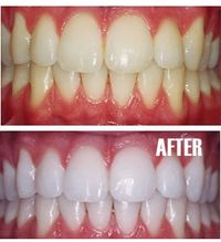 Put a tiny bit of toothpaste into a small cup, mix in one teaspoon baking soda plus one teaspoon of hydrogen peroxide, and half a teaspoon water. Thoroughly mix then brush your teeth for two minutes. Remember to do it once a week until you have reached the results you want. Once your teeth are good and white, limit yourself to using the whitening treatment once every month or two.