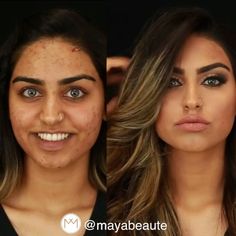 Before and after full acne cover makeup by @mayabeaute Acne Scar Diy, Acne Beauty, How To Contour Your Face, How To Contour, Acne Makeup, Acne Scar Removal