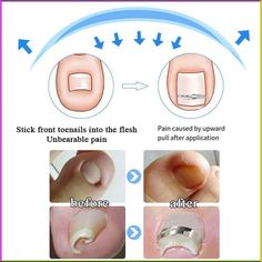 Toenail Recover Corrector Clip Ingrown Nail Care Relief Pain Paronychia Cure, #AD, ##Cure, #ad, #Paronychia, #Pain, #Relief Henna Designs Back, Nails Minimalist, Nails Inspiration Spring, Nail Problems, Ingrown Toenail, Ingrown Nail, Lip Care Routine, Skin Natural Remedies