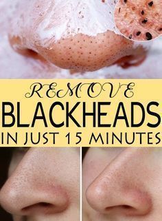 10 Homemade Body Scrubs For Glowing Skin And Their Benefits Remove Blackheads From Nose, How To Get Rid Of Pimples, Blackhead Remover, Wash Your Face