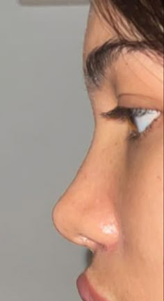 Rhinoplasty Nose Jobs, Job Inspiration, Straight Nose, Pretty Nose, Nose Makeup, Perfect Nose, Small Nose, Nose Surgery, Button Nose