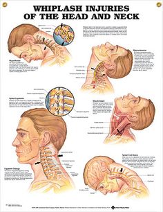 Whiplash Injuries Whiplash Injury, Neck Injury, Neck Exercises, Chiropractic Care, Whiplash, Anatomy And Physiology