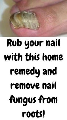 Antifungal Essential Oil, Toenail Problems, Nail Care Diy