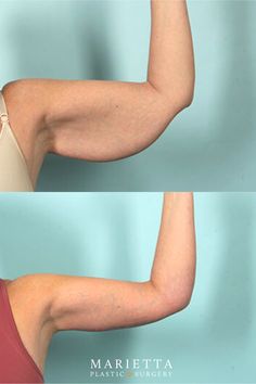 BeforeAfterBrachioplastyA Brachioplasty or arm lift is a procedure performed to remove excess skin and fat from the armsAn arm lift can help you obtain a more defined and toned appearance in the upper arm region. Before And After Arm Workout, Arms Before And After Toned, Before After Aesthetic, Arm Surgery Plastic Before After, Arms Before And After, Arm Lift Surgery Before And After, Skin Removal Surgery Before And After, Arm Lipo Before And After, Thigh Lift Before And After