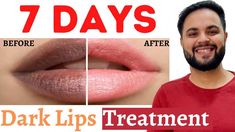 Everyone desires to have beautiful pink lips but external factors ruin the appearance of our lips and make them appear dark and dull. In this video we will t... How To Remove Tan From Lips, Lips Darkness Remove, Lip Tan Removal, How To Remove Dark Lips, Lip Darkness Removal, How To Remove Lip Pigmentation, Upper Lip Darkness How To Remove, Lip Pigmentation Remedy, Dark Lips Remedy