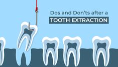 do's and don'ts after a tooth extraction Soft Meals After Tooth Extraction, Food Ideas After Tooth Extraction, Wisdom Tooth Extraction Aftercare, Eating After Tooth Extraction, Wisdom Teeth Extraction, Teeth Extraction, After Wisdom Teeth Removal, Tooth Extraction Aftercare, Tooth Extraction Healing