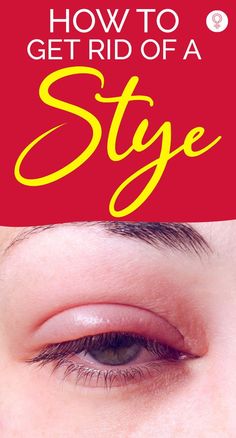 Essential Oils For Eye Stye, What To Do For A Sty In Your Eye, Eye Wash Solution Home Remedies, Eye Inflammation Remedies, How To Get Rid Of A Stye On Your Eyelid, Remedies For Stye On Eyelid, How To Get Rid Of Stye Eye, How To Get Rid Of Swollen Eyes, How To Treat Pink Eye At Home