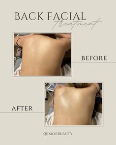 Esthetician Feed Instagram, Esthetician Aesthetic Instagram Feed, Esthician Instagram, Aesthetic Treatments Facials, Spa Facial Photos, Wedding Skin Care Routine, Facial Before And After, Back Facial, Esthetician School