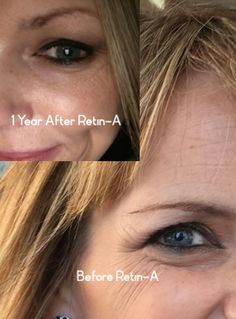 Eye Wrinkles Before And After, Retin A Before And After Wrinkles, Retinol Before And After