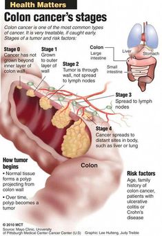 5 Unusual Signs Of Colon Cancer Th Lung Detox, Colon Health, Medical Knowledge, Types Of Cancers, Health Matters, Health Tips