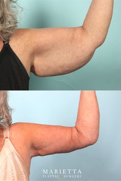 Before & After: Brachioplasty 💪 This patient is 3 months post-op from a Brachioplasty. A Brachioplasty or arm lift is a procedure that removes excess skin and fat to help you obtain a more defined and toned appearance in the upper arm region. Under Arm Fat, Arm Lift Surgery, Defined Arms, Woodstock Ga, Excess Skin, Arm Fat