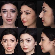 Round Face Nose Job, Nose Job Results, Button Nose Job, Nose Job Inspiration, Nose Job Inspo, Natural Nose Job, Bad Nose Jobs, Dream Nose, Nose Aesthetic