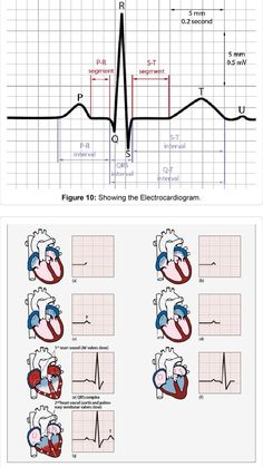 Ekg Electrode Placement, Ekg Placement 12 Lead, Ekg Technician Aesthetic, Cardiac Technician, Stemi Ekg, 12 Lead Ekg Placement, Medical Terminology Study, Cardiology Nursing, Diagnostic Medical Sonography