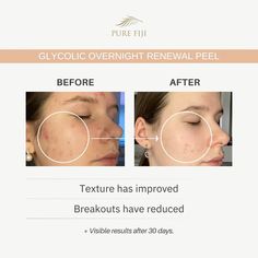 Glycolic Overnight Renewal Peel with Mandelic + Niacinamide (1oz/30ml) – Pure Fiji US Store Blackhead Remedies, Pimples Overnight, Mandelic Acid, Acne Scar Removal, Dry Face, Luminous Skin, Anti Aging Ingredients, Enlarged Pores