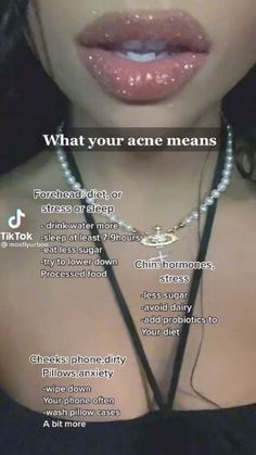 What Different Places Of Acne Mean, Where My Acne Is And What It Means, How To Make Acne Look Good, Acne Meaning On Face, What Ur Acne Mean, Why You Have Acne In Certain Spots, Stuff To Help With Acne, Acne Places Meaning, Diet To Get Rid Of Acne