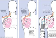 the diagram shows how to use an electric device in order to treat back pain from chest surgery