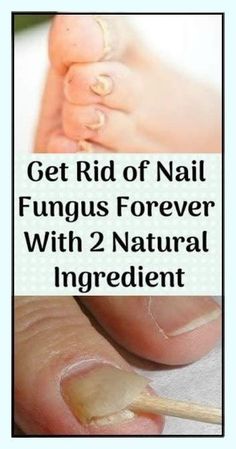 You can eliminate nail fungus with this herbal remedy. It consists of handiest 2 ingredients: | Nail Conditions, Natural Remedies For Allergies, Natural Headache Remedies, Allergy Remedies, Fungal Nail, Health Hacks, Green Nail, Toenail Fungus, Nail Fungus Nail Conditions, Natural Remedies For Allergies, Natural Headache Remedies, Allergy Remedies, Health Hacks, Nail Fungus