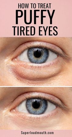 Eye Bag Remedies, Puffy Eyes Remedy, Baggy Eyes, Skin Care Wrinkles, Under Eye Bags, Beauty Remedies, Tired Eyes, Looks Black