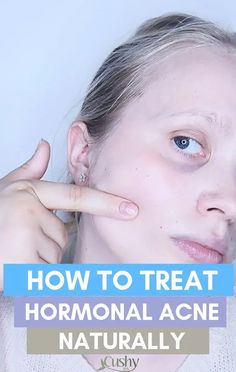 Needs some tips on how to treat hormonal acne naturally? Learn about why you even have it and start using natural products to cure it. Treat Hormonal Acne, Chest Acne, Forehead Acne, Get Rid Of Acne, Acne Treatments, Rid Of Acne, Natural Acne Remedies, Natural Acne, Home Remedies For Acne