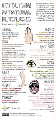 Nutrition Sportive, Nutritional Deficiencies, Body Health, Holistic Health, Healthy Body