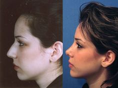 Nose inspo Persian Nose, Rhinoplasty Recovery, Nose Jobs, Hair Implants