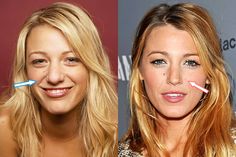 Bulbose Nose, Blake Lively Nose, Books Summary, Face Plastic Surgery, Cheek Implants, Nose Jobs, Botox Lips, Female Surfers