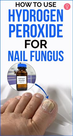 Toenail Health, Toenail Fungal Infection, Nail Remedies, Fingernail Fungus, Toenail Fungus Remedies, Ingrown Toe Nail