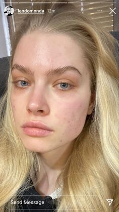 Textured Skin Aesthetic, Pretty People With Acne, Face Imperfections, Lemon Face