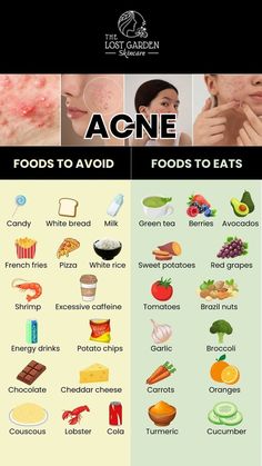 #struggleisreal Acne Free Skin, Food To Eat, Clear Healthy Skin, Natural Acne