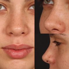 Nose Plastic Surgery, Nose Problems, Nose Reshaping, Face Surgery