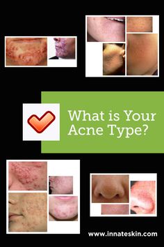 In general, acne and all of its variations are caused by oxidized sebum and clogged pores. Our blog has a list of the main acne types and a little bit of information on what causes them. #typesofacne #typesofacnepictures #typesofacneonface #typesofacnechart #typesofacneandcauses Vitamins For Clear Skin, Acne Pictures, Acne Types, Blind Pimple, Pimples Under The Skin, Skin Care Supplies, Acne Prone Skin Care, Top Anti Aging Products, Skin Diet