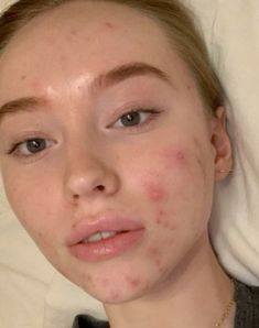 Strawberry Skin, Real Skin, Unique Women, Love Your Skin, Pretty Skin, Real Beauty, Feel Good, Acne, Skin