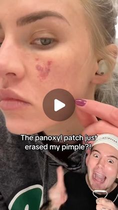 Matt Randon 🧩 on Instagram: "IT LITERALLY DISAPPEARED??!😱 (follow for more!💗)

Credit: @mikzazon #pimple #pimples #pimplepatch #acnepositivity #acneproblems #acnetips #acneskincare"