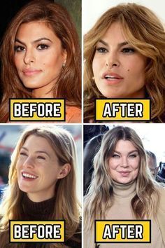 Celebrity Surgery, Cheek Implants, Plastic Surgery Fail, Plastic Surgery Gone Wrong, Face Surgery, Easy Care Hairstyles, Tattoos Men, Hair Mistakes, Celebrity Plastic Surgery