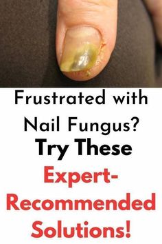 Toenail Health, Toenail Fungal Infection, Polish Recipe, Fingernail Fungus, Toenail Fungus Remedies, Nail Fungus Remedy, Nail Infection, Fungal Nail, Toenail Fungus