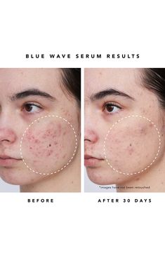 What it is: A clean acne serum that clears and dries up acne blemishes, blackheads and whiteheads with maximum-strength OTC power (2% salicylic acid).Who it's for: Ideal for acne-prone, oily or combination skin.What it does: Plant-derived blue tansy, willow bark, aloe and bisabolol replenish and soothe the skin's barrier and provide hydration. How to use: Apply the treatment serum to clean dry skin on areas of concern twice daily. 1 oz. Natural Beauty & Wellness products are free of sulfates, ph Comedonal Acne, Acne Face Mask, Herbivore Botanicals, Salicylic Acid Acne, Blue Tansy, Acne Serum, Willow Bark, Face Acne, Acne Blemishes