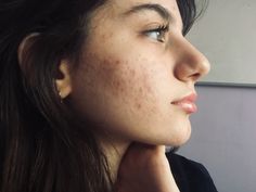 Acne Positivity, Skin Positivity, Lemon Face Mask, Home Remedies For Pimples, Pimples Overnight, Diy Skin Care Routine