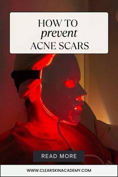 If you desire glowing skin and wonder how to prevent acne scars read this post! Discover natural, effective tips to protect your skin after breakouts. Perfect for your clear skin natural routine and skincare morning habits. Click to learn how to keep your complexion smooth and scar-free!