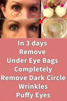 Get Rid Of Deep Wrinkles And Loose Skin Only With This Mixture >>CHECK THIS OUT<< Remove Under Eye Bags, Eye Wrinkles Remedies, Remove Eye Wrinkles, Puffy Eyes Remedy, Wrinkle Remedies, Wrinkle Free Skin, Creme Anti Age, Under Eye Wrinkles, Remove Dark Circles