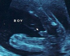 an x - ray image of a baby's stomach with the word boy on it