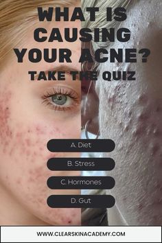 Struggling with acne and not sure why? Take our quick quiz to uncover the root cause of your breakouts and get personalized tips for clear skin! Click the link to find out what’s really going on with your skin.