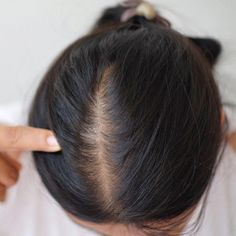 Diffuse Hair, Alopecia Causes, Regrow Thinning Hair, Androgenic Alopecia, Androgenetic Alopecia, Aesthetic Birthday, Birthday Pics