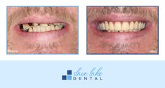 This #transformationtuesday is one of our very own denture patients! We love seeing such a big transformation and it is so amazing to see our patients be so confident in their smiles again <3  This is a photograph of Dr. Kian's Denture patient. Photographs are for informational purposes only, as individual treatment results will vary from patient to patient. Some patients may or may not be candidates for treatment. Call today for your consultation 780-849-2233. Transformation Tuesday, Confidence, Photographer