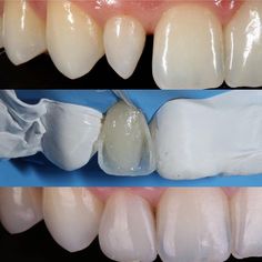 Dental Ceramics, Dental Photos, Dental Aesthetics