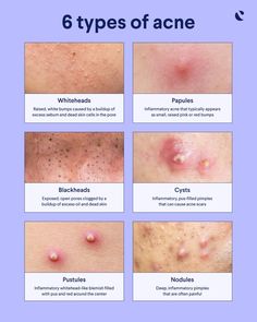 Nodule Acne, Acne Types, Different Types Of Acne, Forehead Acne, Pimples Under The Skin, Natural Acne Remedies, Types Of Acne, Face Acne