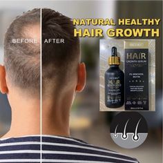 Hair Growth Serum & 5% Minoxidil Treatment For Women & Men For Stronger Thicker Longer Hair Stop Thinning & Hair Loss With This Wonderful Natural Hair Growth Thickening Treatment. Expire: 19/05/2027 New With Box. Shipping Within 24 Hours On Business Days. Thicker Longer Hair, Biotin Hair Growth, Long Hair Color, Hair Growth Serum, Healthy Natural Hair, Coconut Oil Hair, Longer Hair, Growth Serum, Thinning Hair