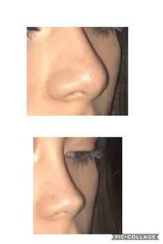 Ideal Facial Features, Nose Job Tape Aesthetic, Natural Looking Nose Job, Rib Removal Surgery Before And After, Upturn Nose, Subtle Nose Job, Nose Job Front View, Nose Job Inspiration