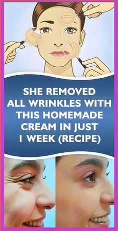 SHE REMOVED ALL WRINKLES WITH THIS HOMEMADE CREAM IN JUST 1 WEEK Get Rid Of Warts, Weight Changes, Natural Cough Remedies, Cold Remedies, Anti Aging Treatments, Lose 40 Pounds, Wrinkle Remover